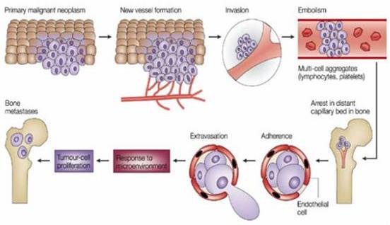 [그림 1. 암세포의 뼈 전이 기전 (출처: Aaron et al. Carcinoid Tumors, 2008)]